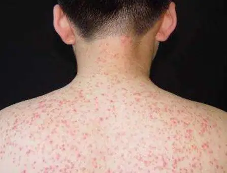 感染性皮炎过敏性皮炎