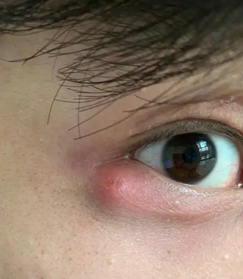 这眼皮下面有个痘痘,它会自己长成熟然后挤掉那种