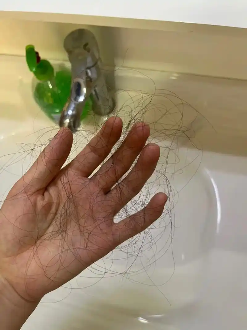 梳一次掉一把,90后的我开始加入秃头大军了,别告诉我只有我一 - 抖音