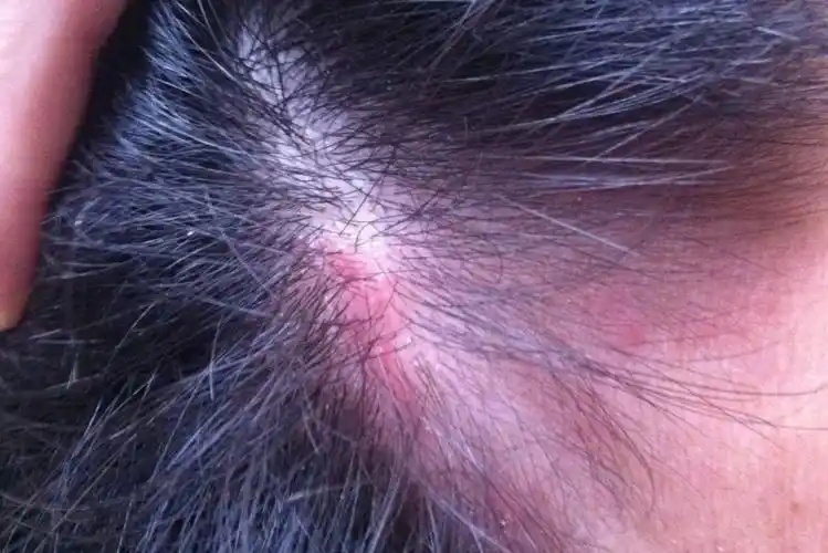 1,细菌性毛囊炎细菌性毛囊炎临床典型症状为粟粒大毛囊性红色丘疹