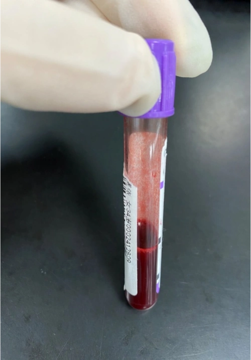 血常规红细胞凝集,温浴无法纠正怎么办?