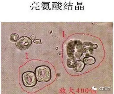 高清图谱,尿液结晶及其临床意义|酪氨酸|黄疸|性疾病|溶血_网易订阅