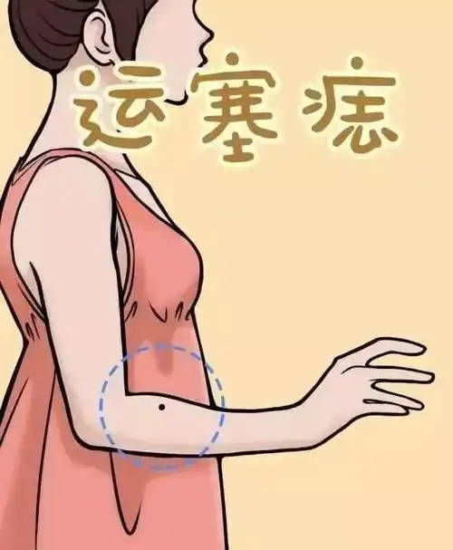 手臂痣相图解