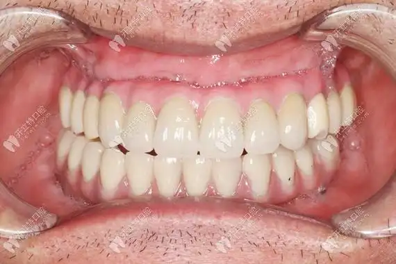 这些都是广州暨大穗华口腔荔湾院区的半全口种植牙病例