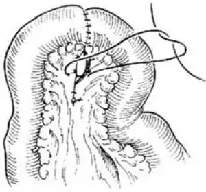 小肠切除吻合术