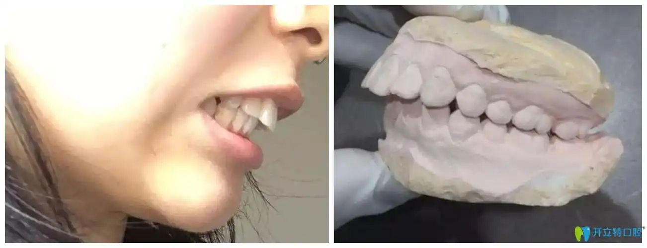 曾一度怀疑东莞利尔口腔我的龅牙矫正是失败的现在很满意