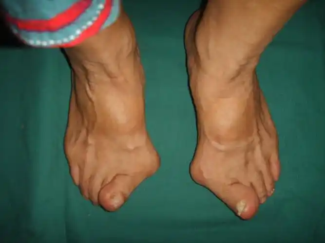 轻度大脚骨有没有必要做手术?长沙22岁女孩还是确定做了