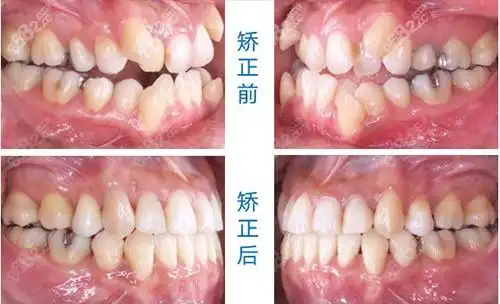 深圳格伦菲尔口腔虎牙矫正前后对比图