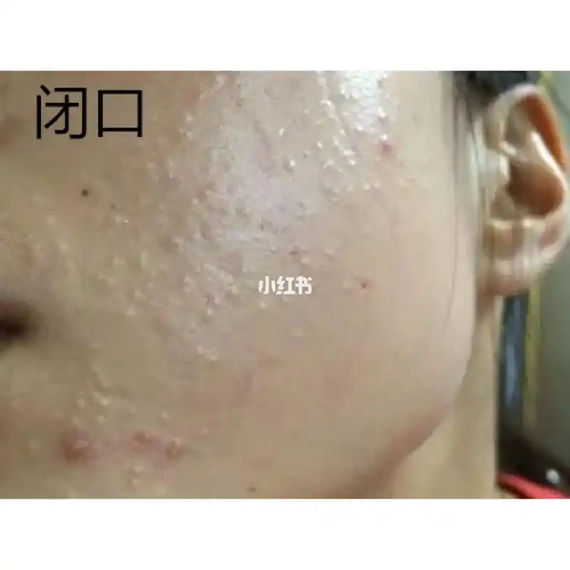 闭口粉刺黑头白头研究一览(图片高能警告