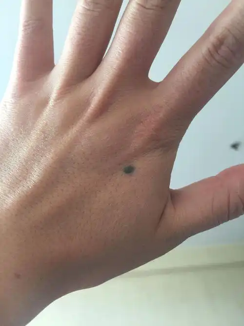 手背这颗痣代表什么?不懂勿言,谢谢.