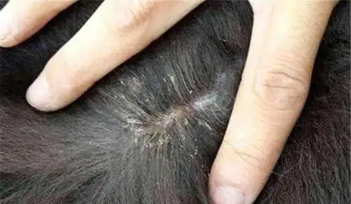 当然农民也会买上篦子梳,这样就可以轻而易举的将虱子捕捉到手里.