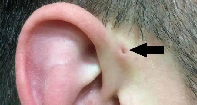 需要当心!|肿瘤|耳轮|瘘管|耳前|瘘口_网易订阅