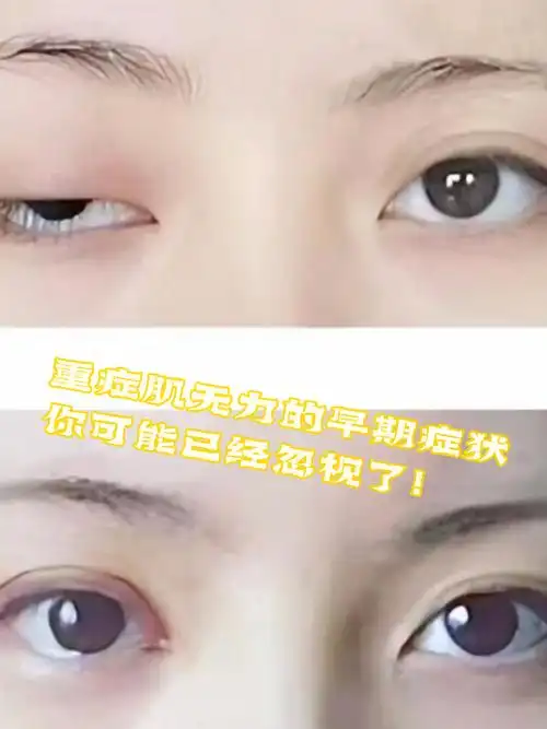 重症肌无力的早期症状,你可能已经忽视了!