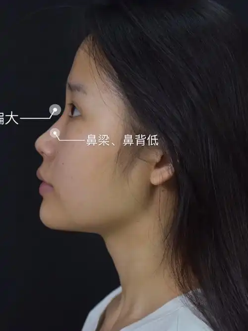 我们一般讲到鼻部美学,很多时候都是从侧脸来进行分析,讲鼻梁的