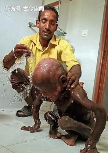 男孩gumoli患罕见"鱼鳞癣"怪病 全身皮肤长满如同水泥异物