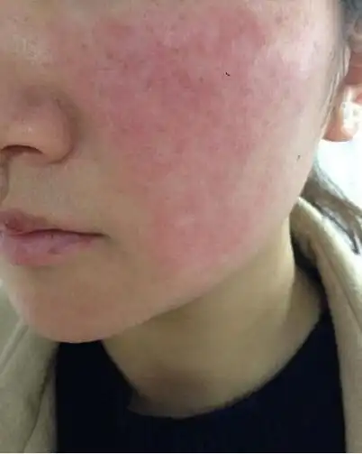小李美肤老师哪些肤质最容易引起面部红血丝