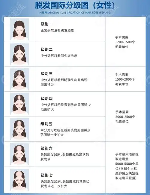前言:根据脱发等级不同,发际线植发的价格是不等的,不论是在哪个城市