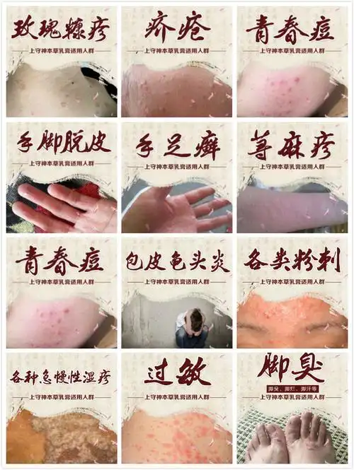 晨隽堂,上守神〗本草乳膏适用于 各种急慢性湿疹(阴囊湿疹,肛门湿疹