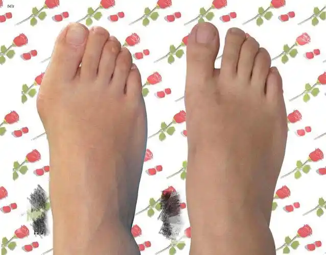 拇外翻的治疗与预防