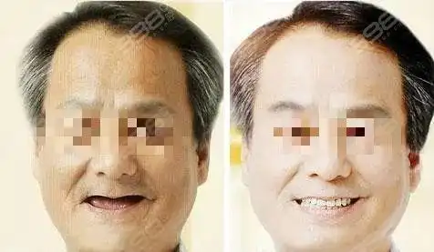 老年人缺牙人必看:八十岁老年人可以做种植牙吗?有什么危害吗?-口腔医
