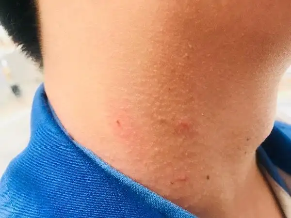 脖子上起了个小肉球,不痛不痒,什么东西啊?