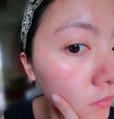 螨虫过敏症状图片大全