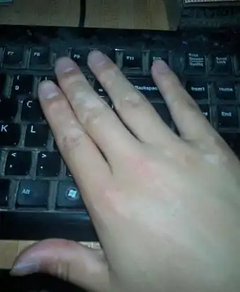 白癜风(白斑病)的症状(图片)