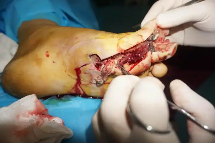 一期清创,见跖底筋膜坏死,沿屈肌腱鞘延伸到踝关节有脓性分泌物伴恶臭