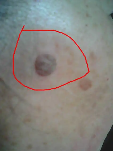 奶奶脸上长了个东西,不知是什么,如图,怎样去除它呢