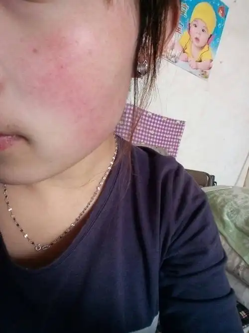 女生19岁了 脸老是泛红 敏感型皮肤 特别敏感 遇冷遇热都会泛红 什么