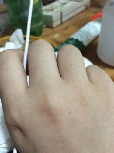 今天早上起来,突然发现右手手背上长了好多小麻点,红色的,不痛不痒