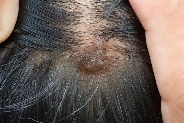 头部脂溢性皮炎图片(头皮上长出的脓包与疙瘩是什么物质) - 赤虎壹号