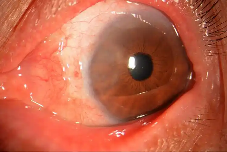 翼状胬肉手术后眼睛红图片