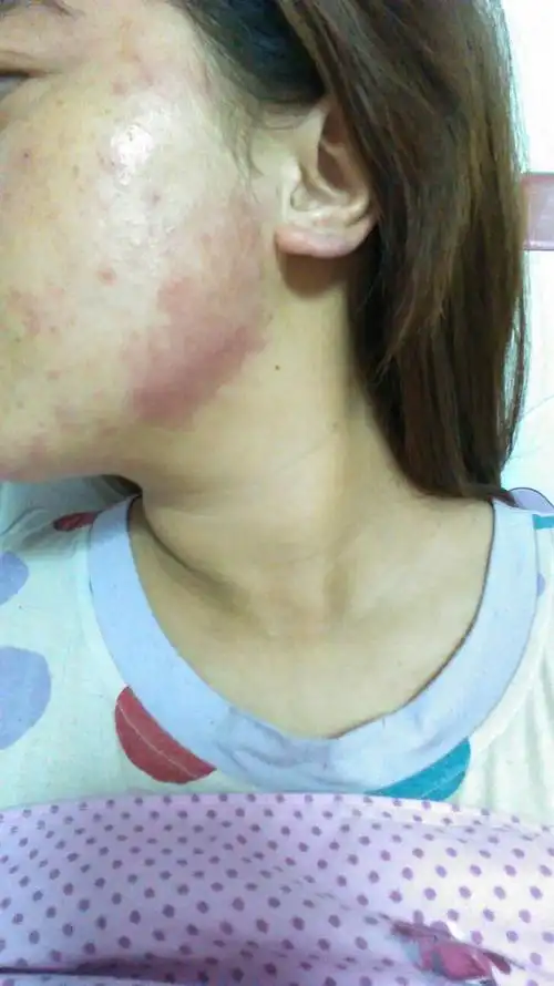 品过敏了,起了很多小疙瘩,小水泡,现在还脱皮,脸部红红的,皮肤还很干