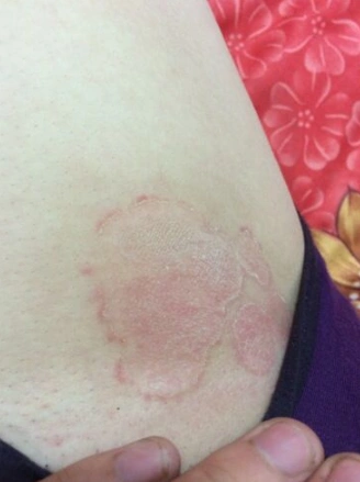 体股癣初期现象图片8