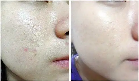 秋季皮肤为何越变越粗糙?