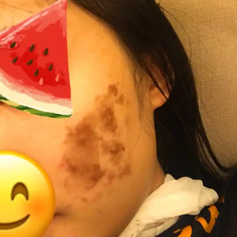 刷酸后第四天,慢慢掉痂