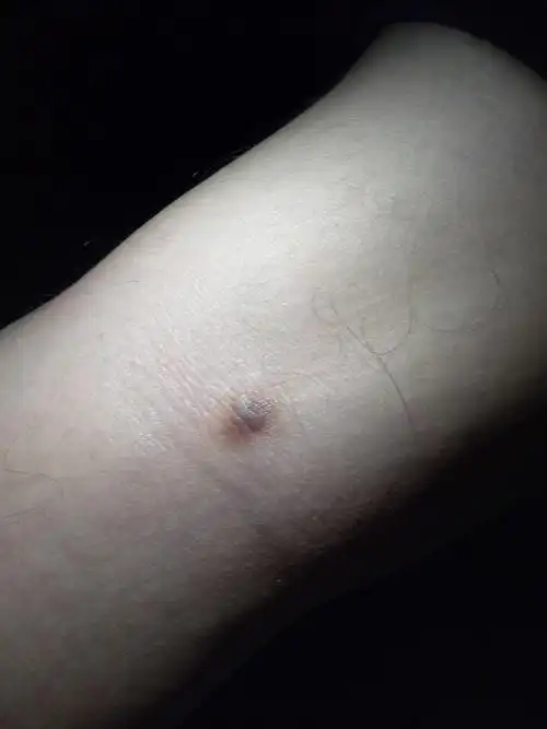 我腘窝(腿关节后面)处长了一个疙瘩,是痣还是黑色素瘤还是什么?