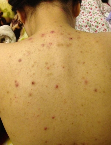 前胸后背的毛囊炎怎么治林雯老师教你怎么治好得快