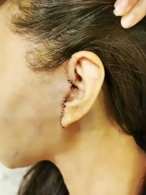 【菲斯莱茵迷你拉皮术后第一天】