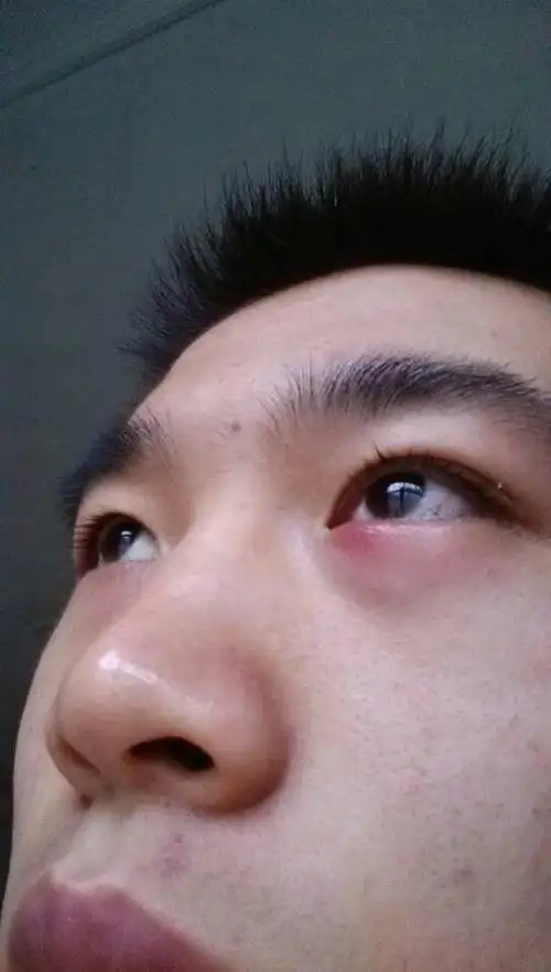 请问医生这是什么病,应该用什么治疗,我用红霉素眼膏不管用啊 ,第二天