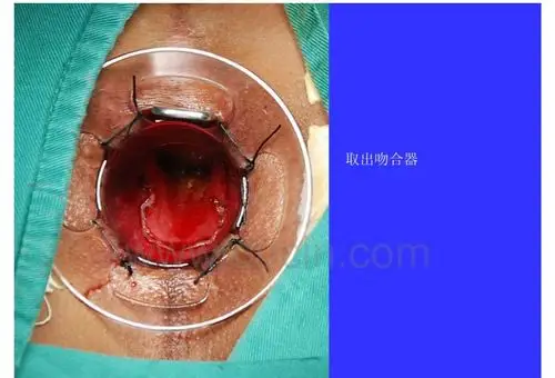 写美篇直肠前突症状体现: 1.