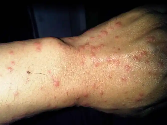 之前得了一次,现在又复发了,贵阳医学院说是过敏.