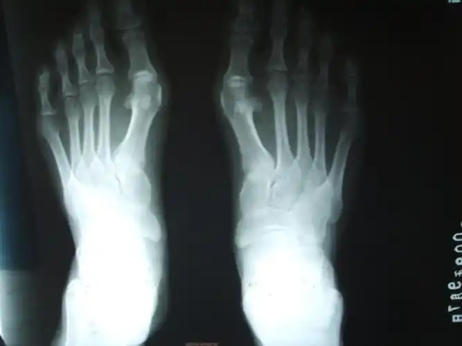 大脚骨的疼痛要如何缓解,大脚骨医生和你讲一讲,看清楚