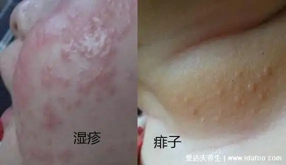痱子和湿疹的区别图片,外貌症状都不相同一眼可分辨