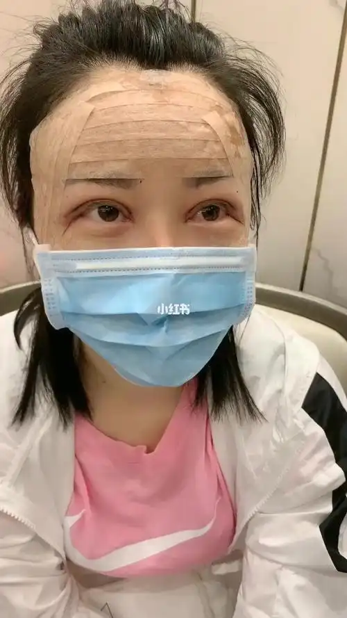 今天第二天脂肪填充77眼睛