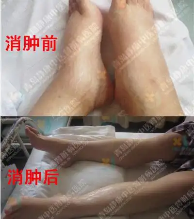 花季少女血肌酐正常 狼疮性肾炎再不用怕了