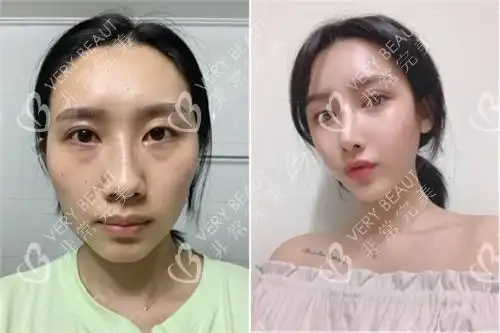 韩国可来熙自体脂肪面部填充真人日记图分享,全脸饱满不假