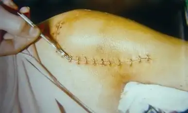 缝合结束后,完全松开手柄,将吻合器退出