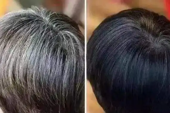 少白头是一种病因复杂的青少年白发病,一般有两大类型,先天性白发和